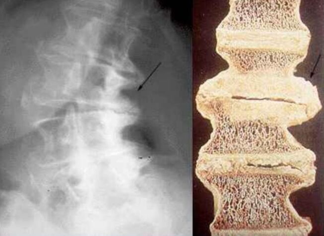 Danos ás vértebras na osteocondrose torácica