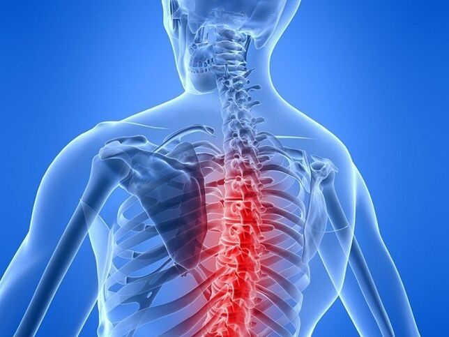 Osteocondrose da columna torácica