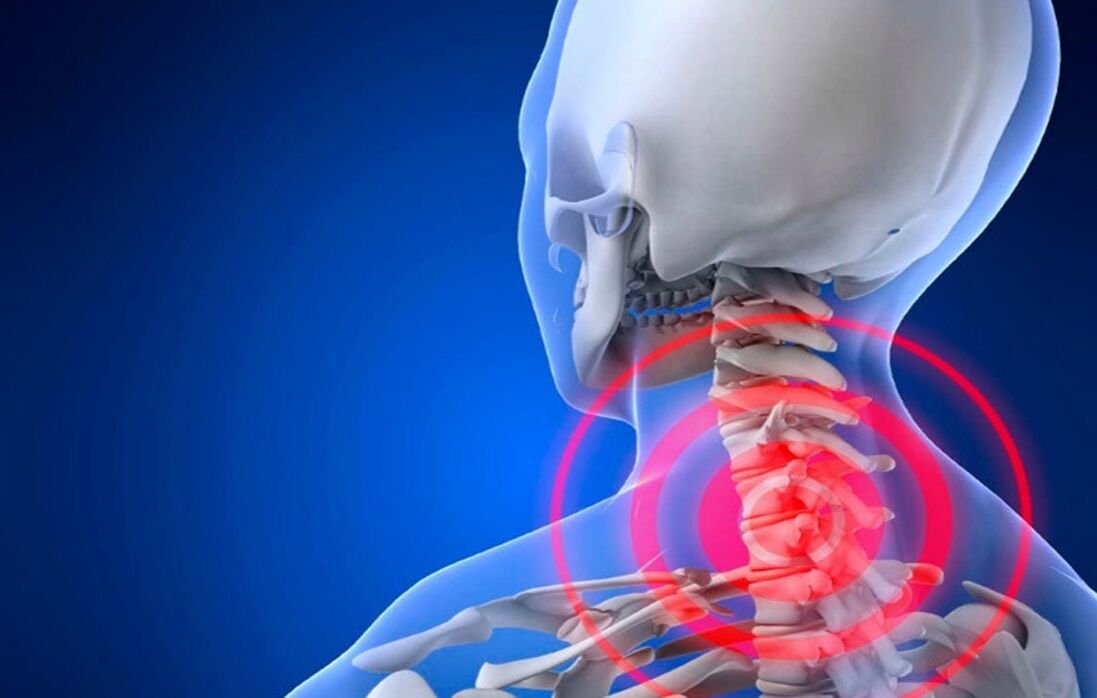 Osteocondrose da columna cervical