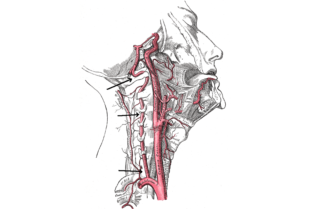 Compresión da arteria vertebral con osteocondrose cervical