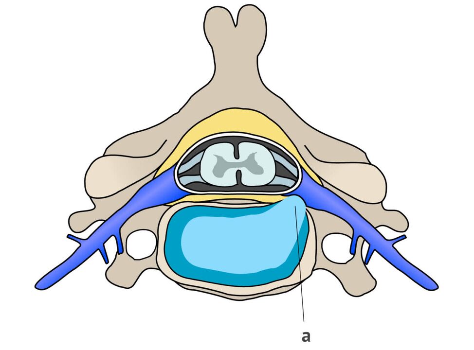 Hernia intervertebral con osteocondrose cervical