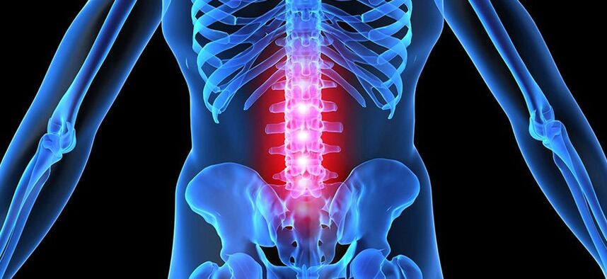 Características da osteocondrose lumbar
